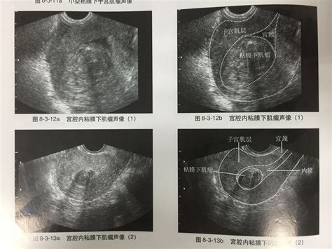 宫腔内囊性回声可以排除宫外孕吗