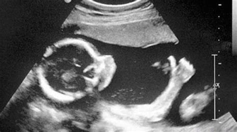 16周b超胎儿图