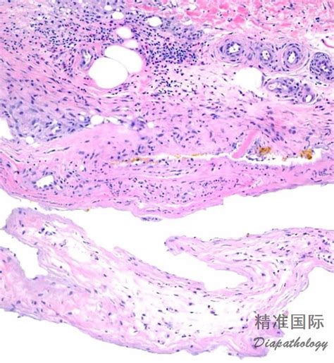 新生儿皮脂硬化怎么防治