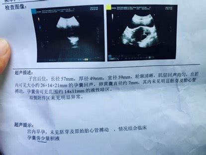 hcg0.10有怀孕的可能吗