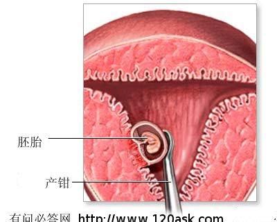 切除牙息肉疼不疼