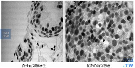 牛奶对前列腺有危害吗