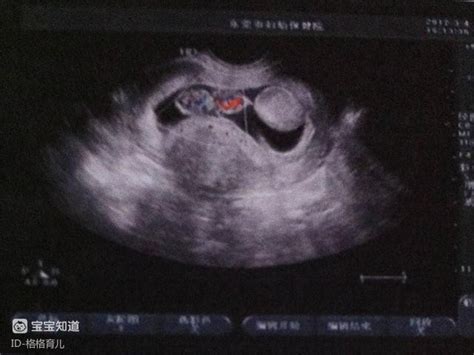 正常怀孕六周的胎儿有多大