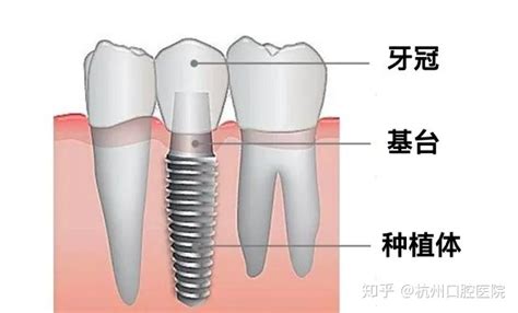 种植基台后多久种牙冠