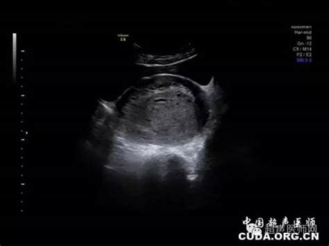 宫外孕hcg值比正常怀孕高还是低