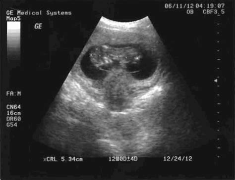 怀孕一个月b超图像