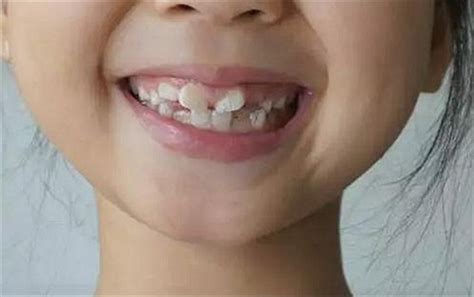 牙齿矫正最晚多少岁