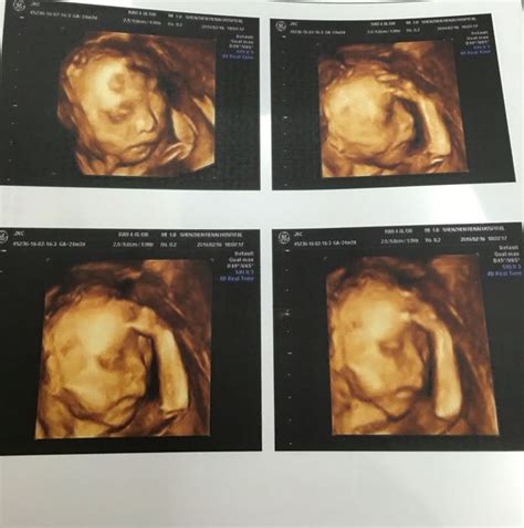 孕22周的宝宝四维彩超图片