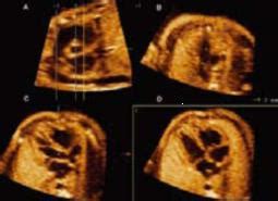 胎儿心脏有缺口案例多吗
