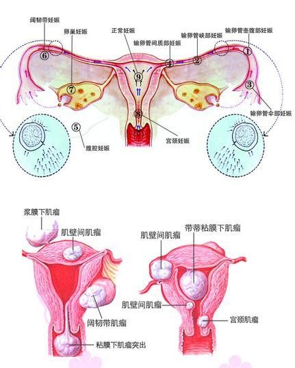 输卵管堵塞可以做人工授精吗