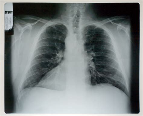 X光射线对人体的伤害有哪些,什么射线对人体损伤最大