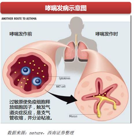 治愈哮喘和气管炎偏方