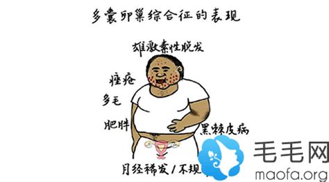 女性多囊卵巢怎么治