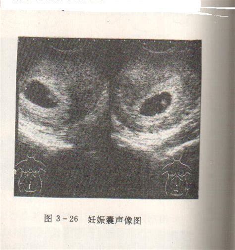 怀孕3个月胎儿形状图