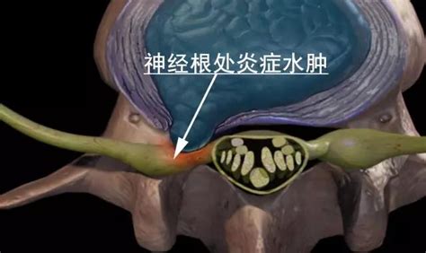 剖腹产后遗症腰疼