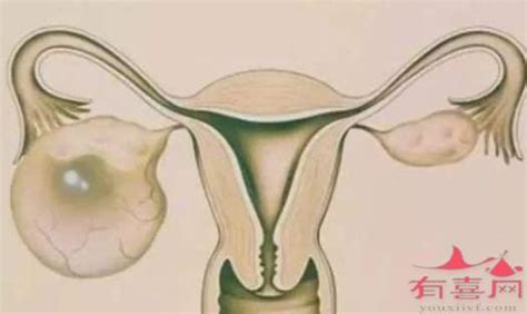 多囊卵巢的症状表现影响怀孕吗