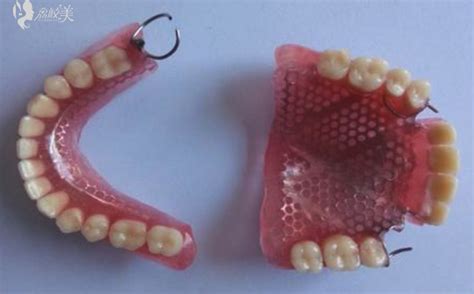 镶牙固定义齿哪种好