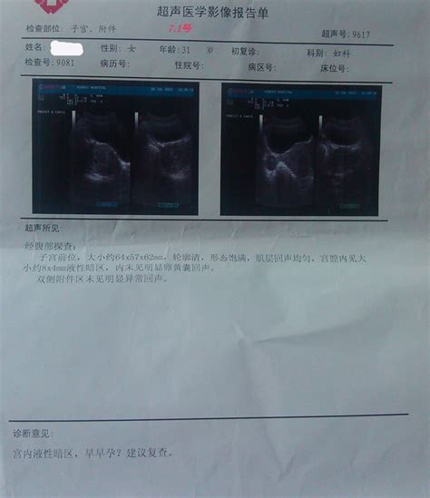 怀孕期间一共要做几次B超