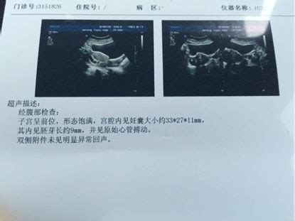 怀孕6周的胚芽有多大