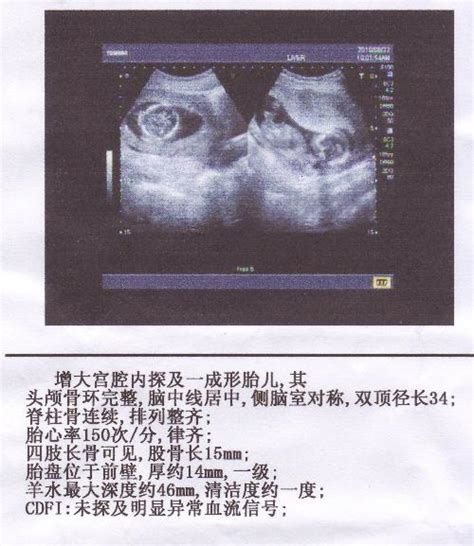 怀孕b超单图片