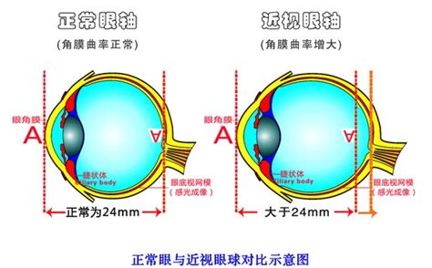 右眼150度左眼100算真性近视吗