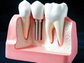 种植牙基台安装后多长时间装牙冠