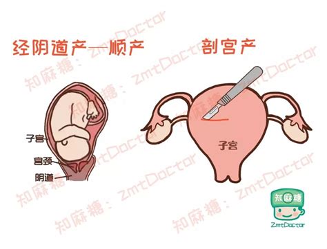 影响孕妇选择自然分娩的因素