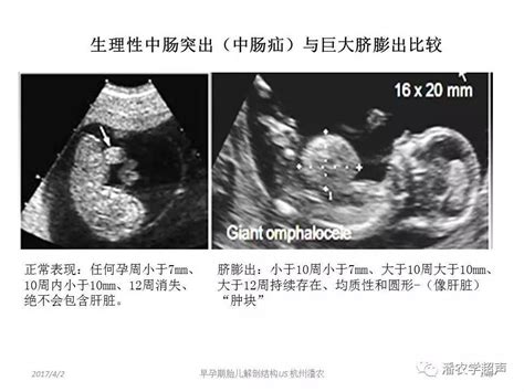 胎儿四肢偏短是几周