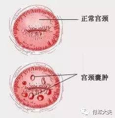 子宫颈表面有多个青白色的小囊泡