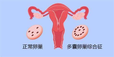 卵巢多囊样改变和多囊卵巢综合征区别