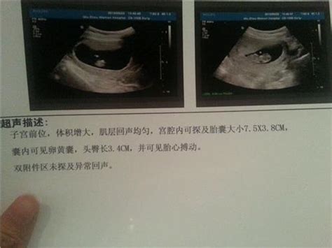 怀孕三个月胎儿的位置图片