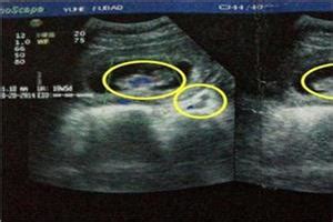 三胞胎怀孕八个月超大肚子图片