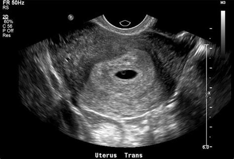 怀孕多久能看到囊性暗区