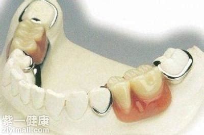 树脂假牙可以长期放在嘴巴里吗