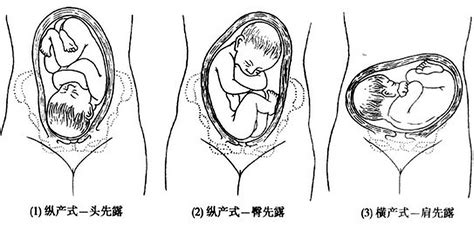 臀位纠正胎位的9个方法图