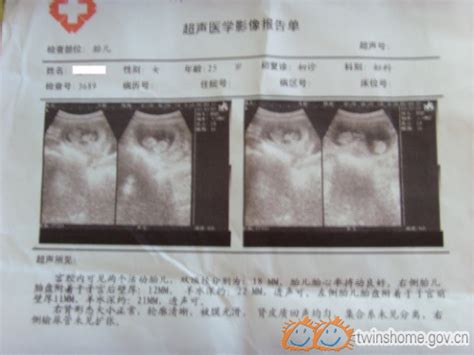 双胞胎孕妇1-10月肚子变化图