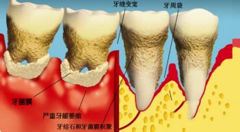 孕妇牙周炎怎么办?痛得厉害怎么办