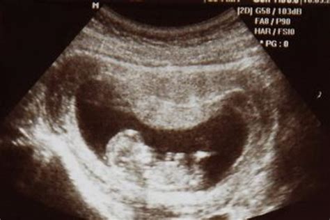 怀孕14周胎儿彩超图片