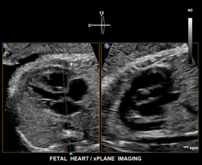 32周胎儿心脏有强回声点