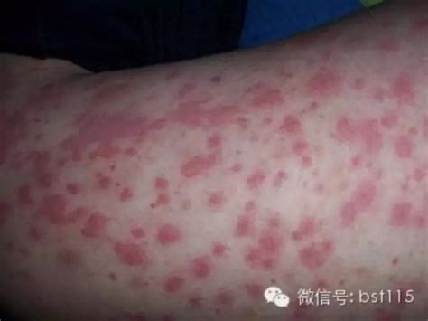 小儿过敏性紫癜吃什么好