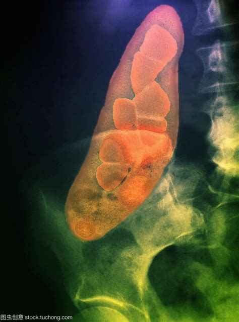 钙流失是怎么回事儿