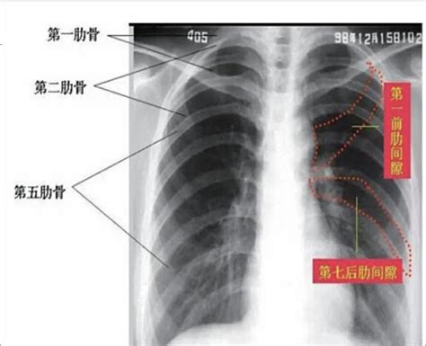 左侧肋骨下方位置图片