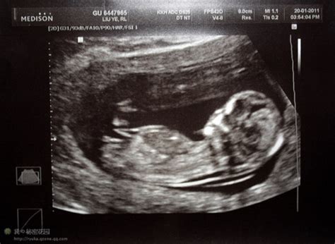 怀孕十个月胎儿b超图片
