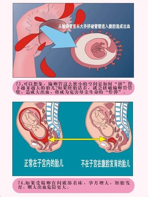 宫外孕开腹手术后三天能吃水果吗