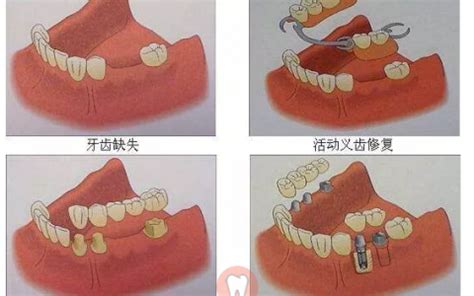 半口假牙收费标准