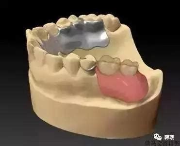 装的假牙能做磁共振吗