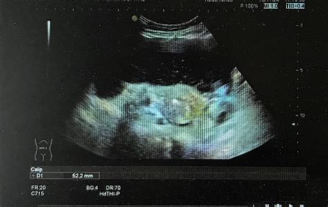 胎儿腹部液性包块