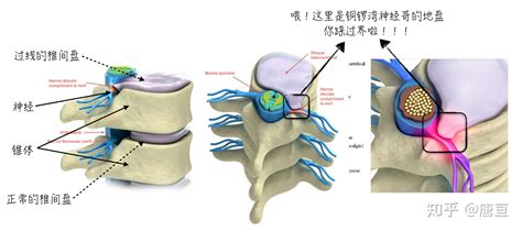 腰间盘突出带护腰带有用吗