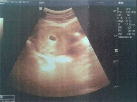 怀孕八周的胎儿b超图片
