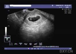 怀孕6周孕囊2厘米